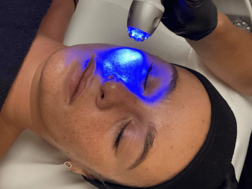 Microneedling : régénération cutanée en profondeur